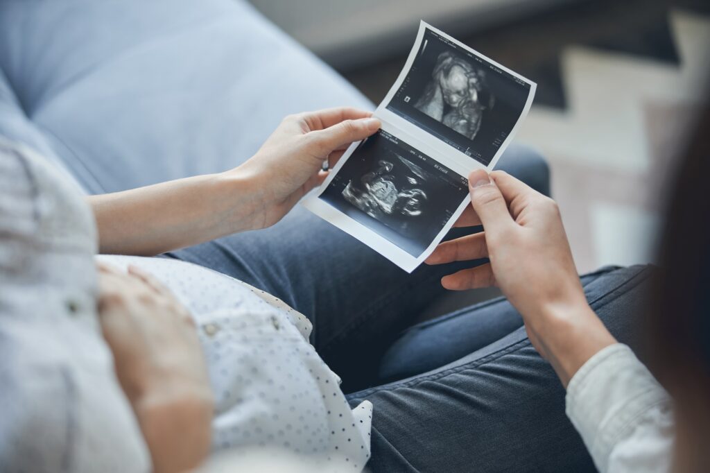 First picture of the baby after ultrasound scanning